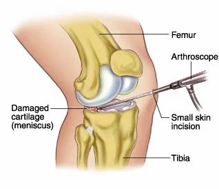 arthroscopic-meniscus-repair-surgery-500x500.jpg