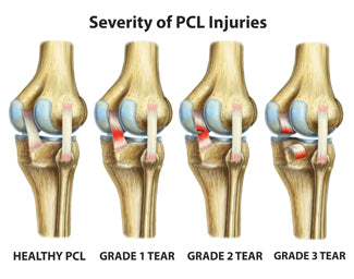 grade-of-pcl-tear-injuries.jpg
